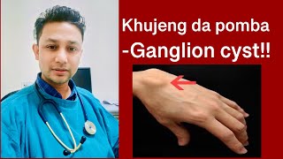 khut khujeng da pomba ganglion cyst [upl. by Ronnica]