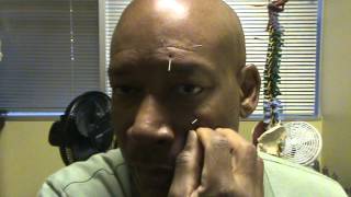 DIY Acupuncture Dr Rodrigues for Trigeminal Neuralgia [upl. by Tsirc]