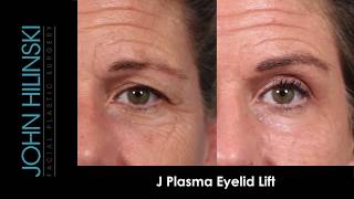 NonSurgical Eyelid Lift [upl. by Yokoyama23]