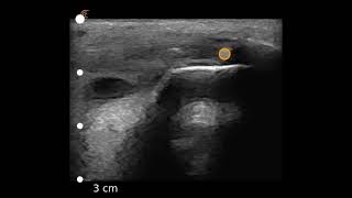 Image Interpretation Achilles Tendinopathy at Insertion [upl. by Annabelle]