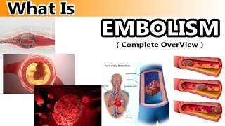 What is Embolism  Clear amp Complete Overview [upl. by Prober992]