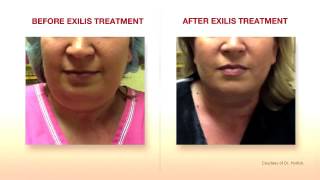 Exilis Elite Face Treatment Amara Clinic [upl. by Cochran]