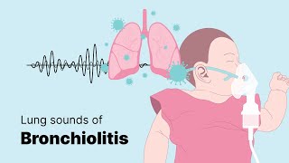 Sounds of Bronchiolitis  Lung Sounds [upl. by Madea649]