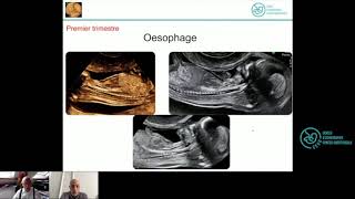 Tube Digestif Normal  Formation Echographie Obstétricale Maroc [upl. by Kenrick]