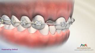 Orthodontic amp Restorative Treatment for Missing Lateral Incisor  Different Options [upl. by Nibuz]