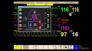 Hemodynamic monitoring in cardiogenic shock DrPuneet Goyal [upl. by Hudis997]