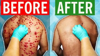 How To Cure Shingles in 2024 [upl. by Ecinrev]