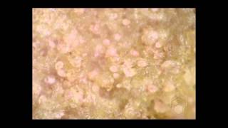 Scabies mites on skin crust [upl. by Bourn418]