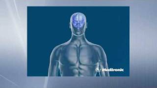 Deep Brain Stimulation  How does DBS work [upl. by Lainad]