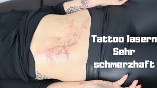 4 Tattoos entfernen lassen  Tattoo lasern  mein Bauch wird gemacht [upl. by Alyaj171]