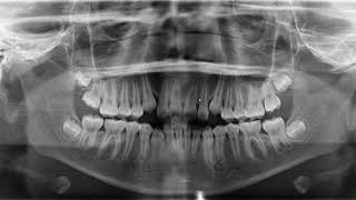 Interpretation series panoramic radiograph  normal or abnormal [upl. by Parrnell10]