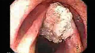 Cancer of the larynx vocal cords cancer [upl. by Gwennie870]