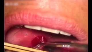 Drenaje de un absceso periamigdalino  Peritonsillar abscess drainage [upl. by Mosi]