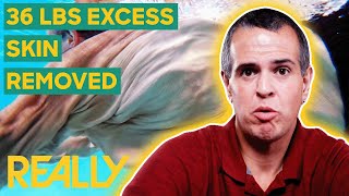 Man Goes Through Emotional Transformation After 479lb Weight Loss  My Extreme Excess Skin [upl. by Waldemar]