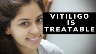 Hindi  Vitiligo treatment is possible know How [upl. by Gauldin]