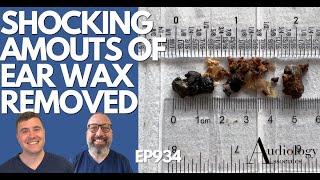 SHOCKING AMOUNTS OF EAR WAX REMOVED  EP934 [upl. by Montgomery101]