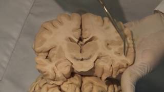 Cortical Localization Neuroanatomy Video Lab  Brain Dissections [upl. by Grosz]