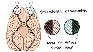 Understanding Bitemporal Hemianopia [upl. by Crifasi]