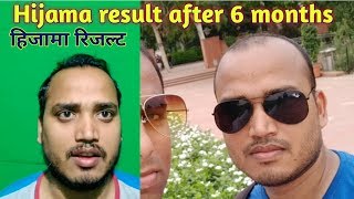 Hijama result after 6 month  हिजामा परिणाम 6 महीने के बाद hair hijama hijamacenter hairstyle [upl. by Lohner]