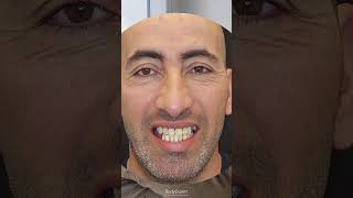 DENTISTE EN TURQUIE  🦷 Témoignage de Faouzi  3 implants dentaires  24 couronnes Emax  BODYEXPERT [upl. by Arlee]