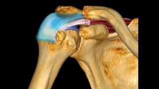 Supraspinatus Pathology [upl. by Maisie]