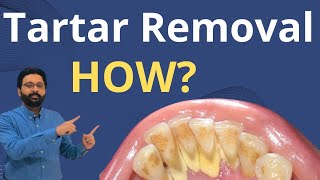 Tartar Removal from Teeth  Dental Teeth Cleaning [upl. by Yelbmik79]