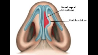 Hematoma Septal [upl. by Anai]