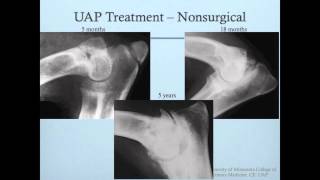 Ununited Anconeal Process UAP [upl. by Matt]