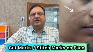 Cost of Cut MarksStitch Marks Removal Treatment [upl. by Enomor9]