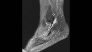 Peroneus longus tendon rupture in plantar foot [upl. by Parshall296]