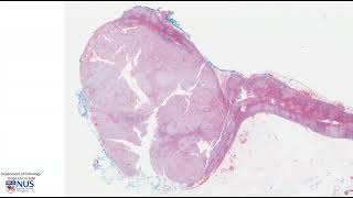 Adrenal gland Adrenocortical adenoma  Talking slide [upl. by Ehttam]