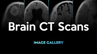 Brain CT Scans Image Gallery [upl. by Nawiat]