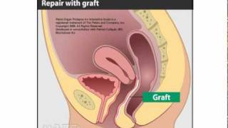 Surgical Treatment for Rectocele [upl. by Infeld980]