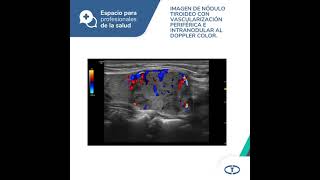 Espacio para Prof  Ecografía tiroidea con elastografía en el diag del cáncer de tiroides [upl. by Freddi473]