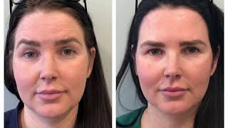 Botox Before and After [upl. by Jeremiah]