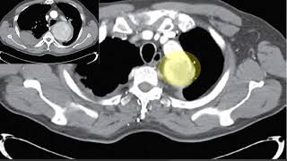 Patient is haemodynamically stable at present [upl. by Lynn]