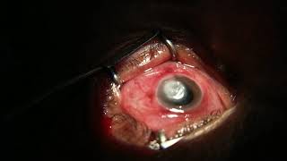 Fungal keratitis intrastromal antifungal therapy [upl. by Arramas]