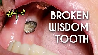 ASMR Broken Tooth Extraction [upl. by Eirrol]