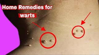 How to remove warts home remedies [upl. by Mastrianni]