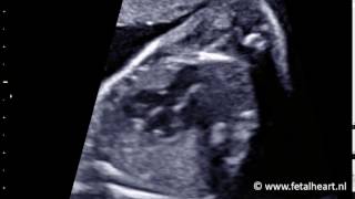 Fetal heart Academy  Tetralogy of Fallot 1 LVOT [upl. by Cassey]