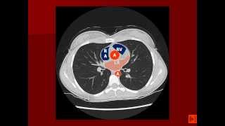 Normal Chest CT with labels [upl. by Ynitsed]