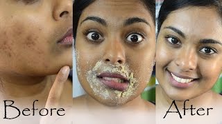 How To Get Rid Of Hyperpigmentation Dark Upper Lip Dark Spots amp Acne Scars Naturally At Home [upl. by Rimidalv690]