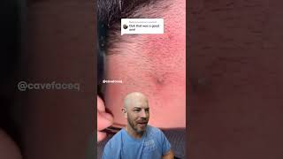 EXTREME ingrown hair drreacts ingrownhair supersatisfying [upl. by Rad]