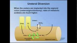 Normal Anion Gap Metabolic Acidosis ABG Interpretation  Lesson 9 [upl. by Lea]