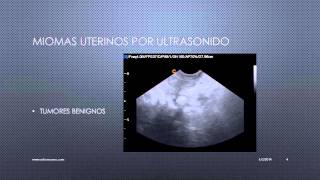 MIOMAS UTERINOS VISUALIZADOS POR ULTRASONIDO [upl. by Marquet]