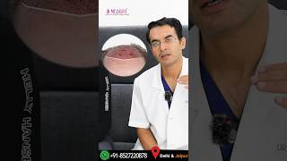 3500 FUE Grafts Hair Transplant by Dr Suneet Soni at Medispa Hair Transplant Clinic in India [upl. by Ajtak532]