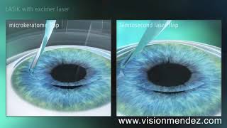 LASIK vs FEMTOLASIK [upl. by Ahseihs]