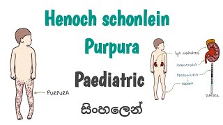 Henoch schonlein purpura  HSP  සිංහලෙන් [upl. by Mehalek]