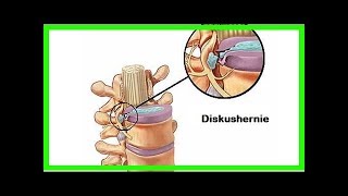 Bandscheibenvorfall – was sind die Symptome [upl. by Ijan]