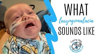 What Laryngomalacia Sounds Like  noisy breathing  newborn congestion [upl. by Denzil996]